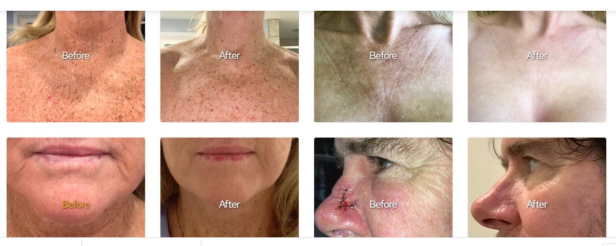 The Proof Is in the Serum! Before and After Images with Virg-N